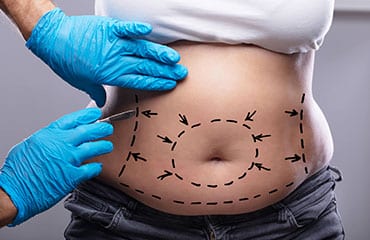 Abdominoplasty